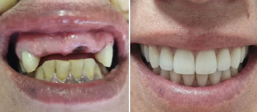 Diseño de Sonrisa en Pilar - Odonto Concord