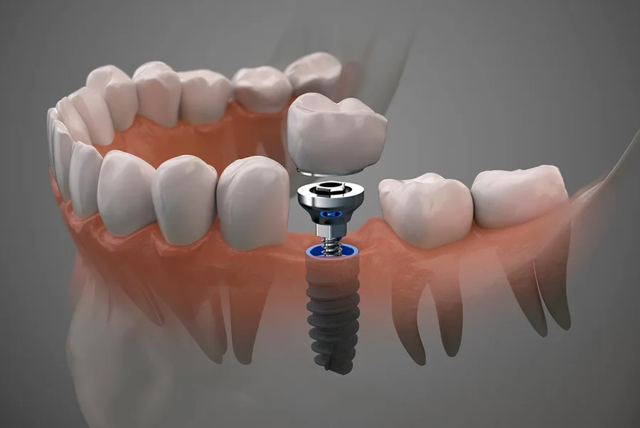 Evaluación para implantes dentales en Pilar con tomografía y análisis de hueso