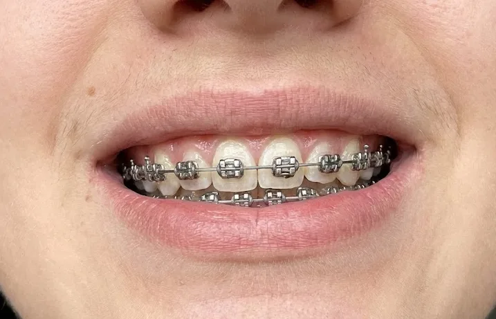 Ortodoncia en Pilar con brackets y alineadores en Odonto Concord